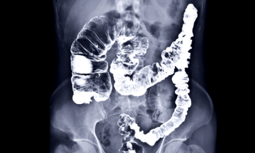 An x-ray of colorectal cancer