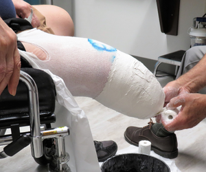 Photo of an amputation being bandaged 