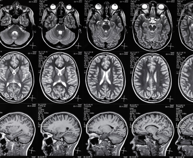 MRI Brain Imaging
