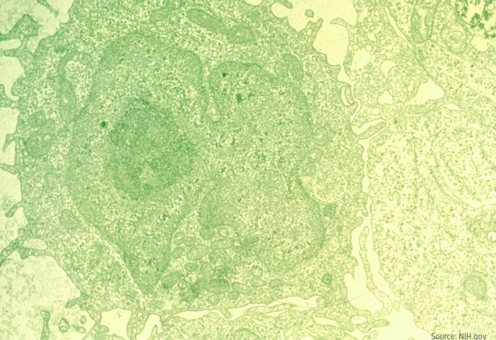 Leukemia histology from NIH